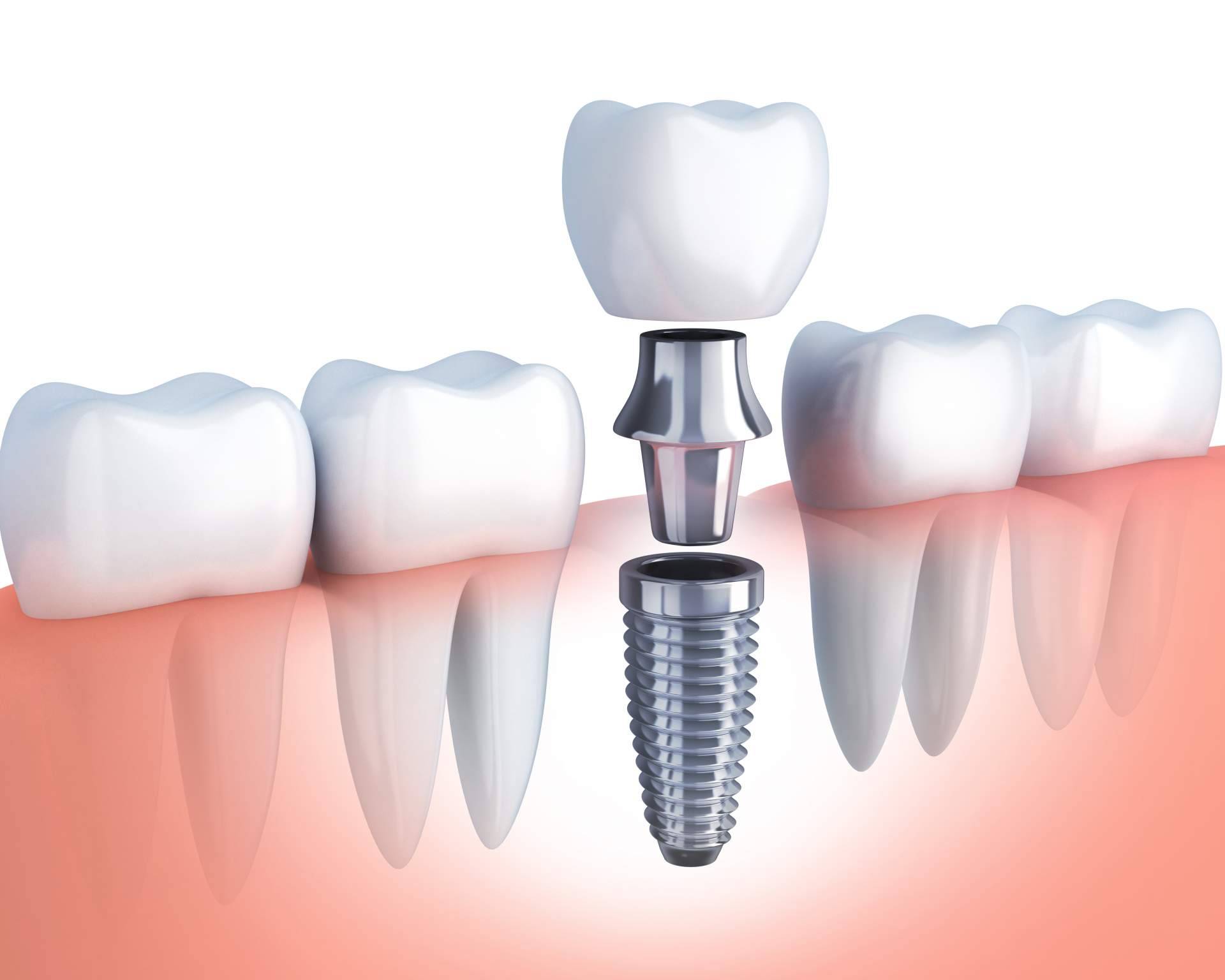 El implante dental de titanio V ha permitido recuperar la masticación y la sonrisa de miles de bocas gracias a la Clínica Artydents en Madrid