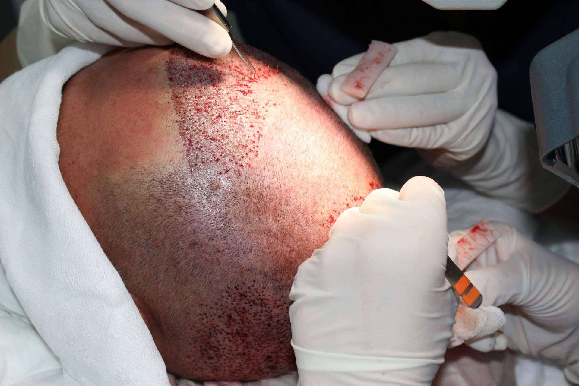 La clínica de injerto capilar en Murcia especializada en el injerto sin cicatriz, Injermur