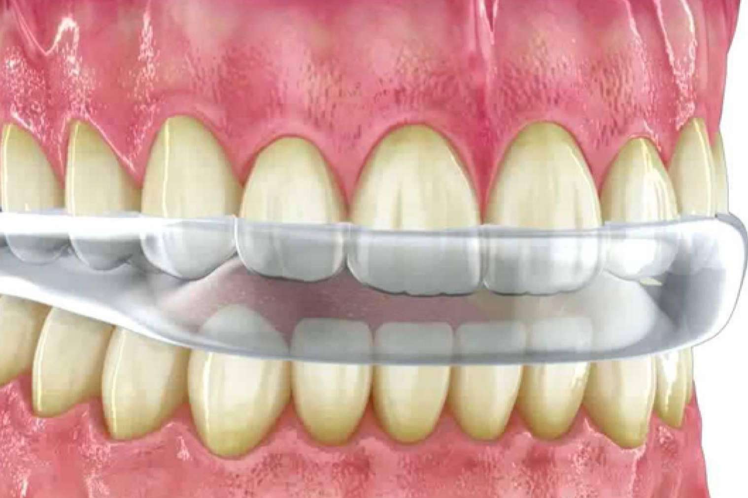 El bruxismo, ¿qué es y cómo se puede solucionar?, por Implant Clinics