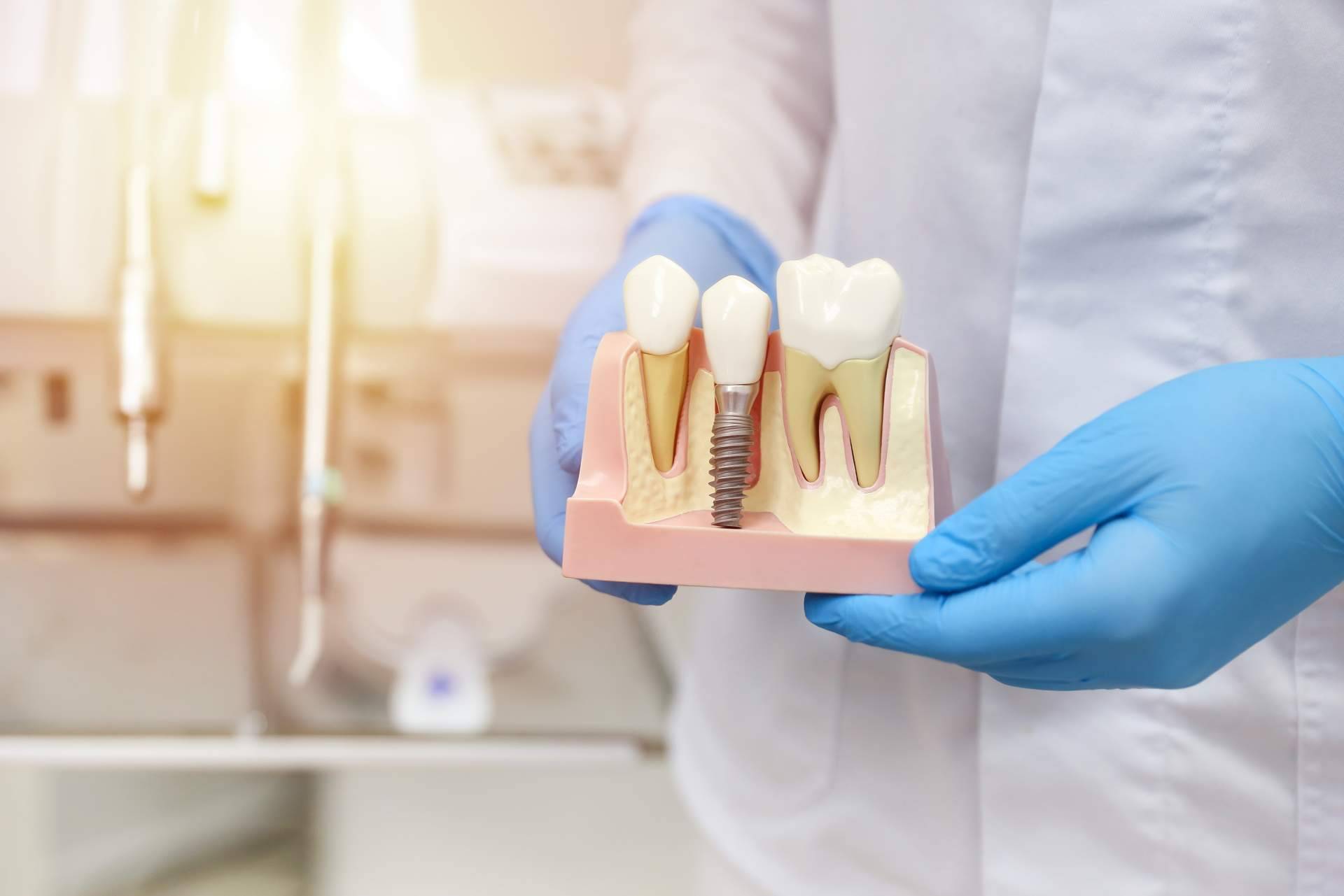 Implantes postextracción con carga inmediata, la técnica por la que apuesta Clínica Dental Sonrisas para conseguir una dentadura de 10 en sus pacientes