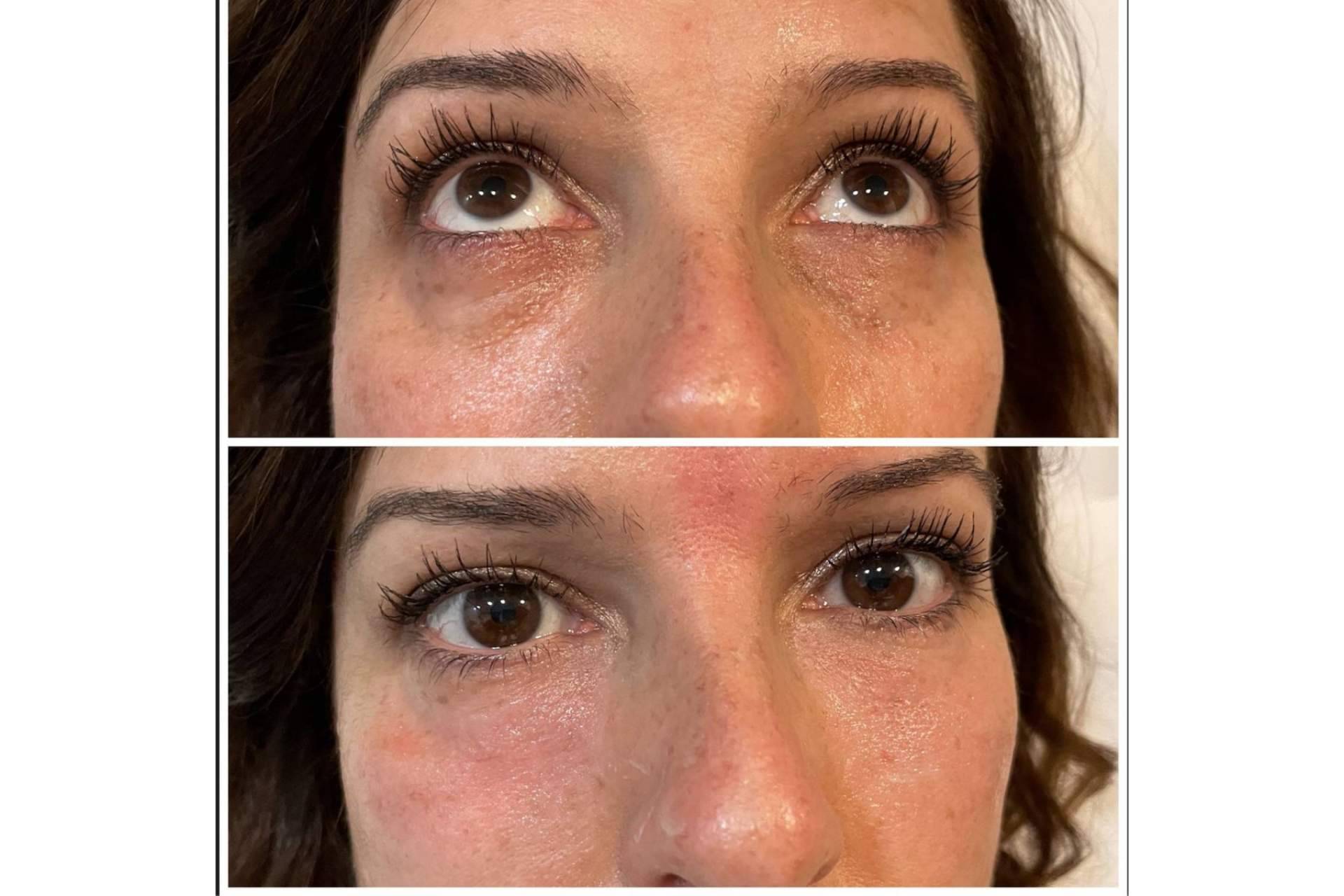 Despertar la mirada de la mano de Cecilia Arthur y su tratamiento de relleno de ojeras con ácido hialurónico