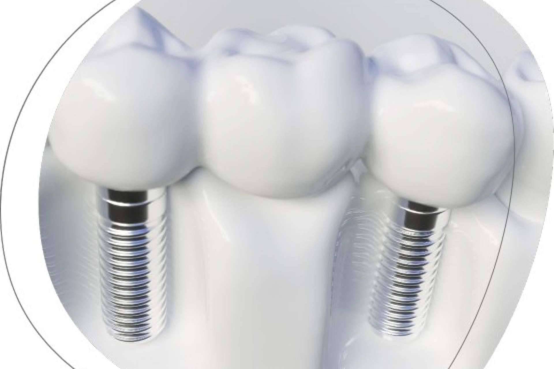 La Clínica Dental Agudo Rosa de Albacete es especialista en implantes dentales