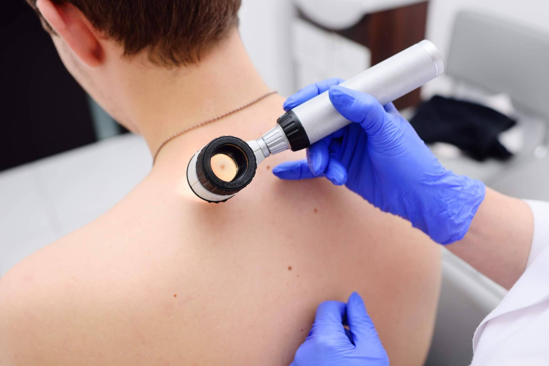 Protegerse ante los melanomas a través de buenos hábitos al sol como medida de protección