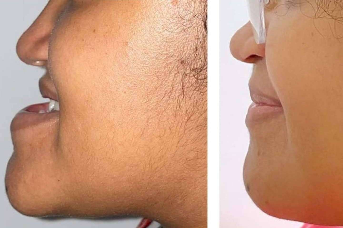 Clínica Calvo de Mora explica qué es la cirugía ortognática