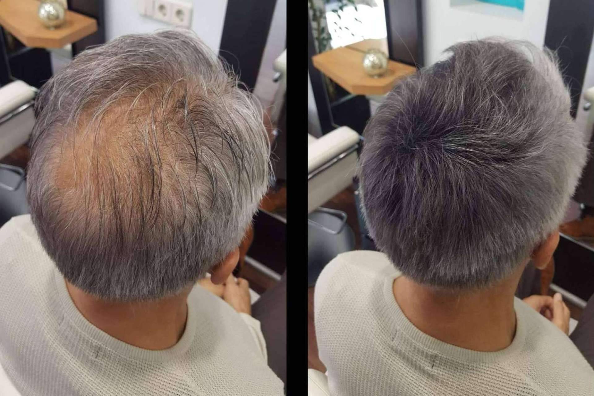 España es el segundo país del mundo con mayor tasa de pérdida de pelo, Lion Hair explica la situación