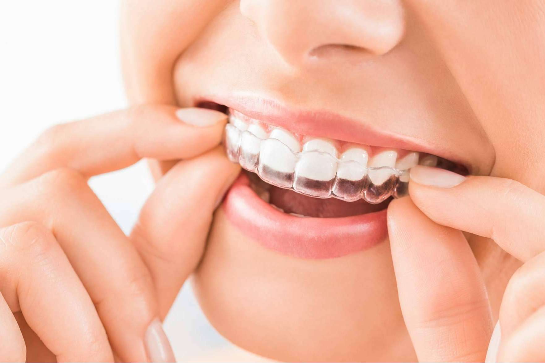 Cómo tener una sonrisa de cine sin gastar un euro, en Clínicas Nobel