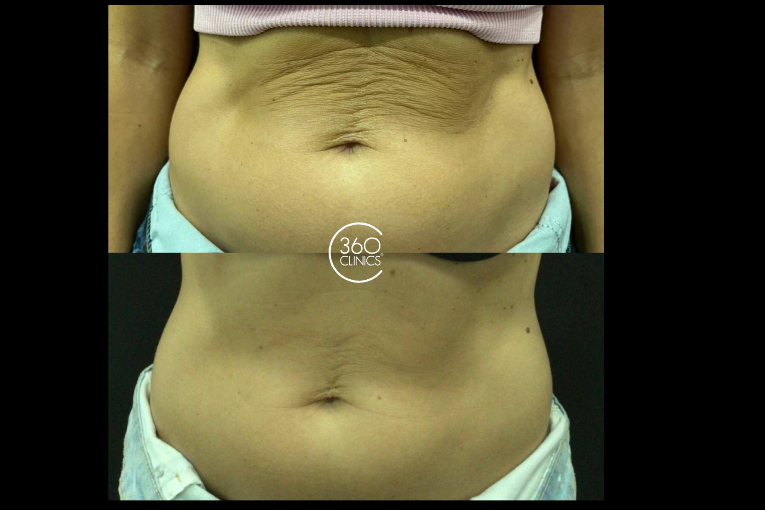 El tratamiento revolucionario para combatir flacidez y celulitis en 360 Clinics