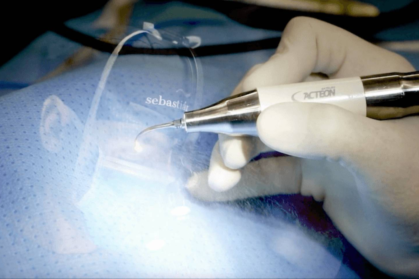 La rinoplastia entra en una nueva etapa gracias a la tecnología ultrasónica
