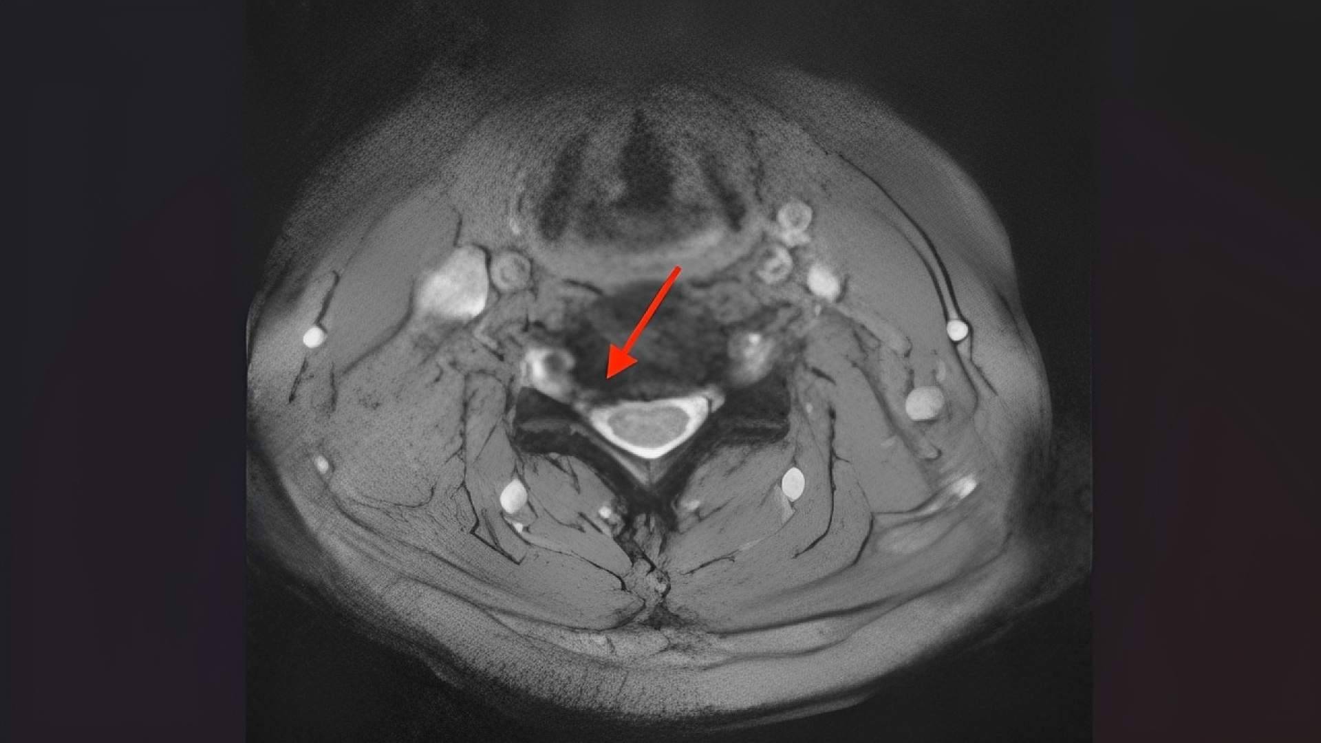 ¿Es posible tratar una hernia cervical sin fusionar las vértebras?